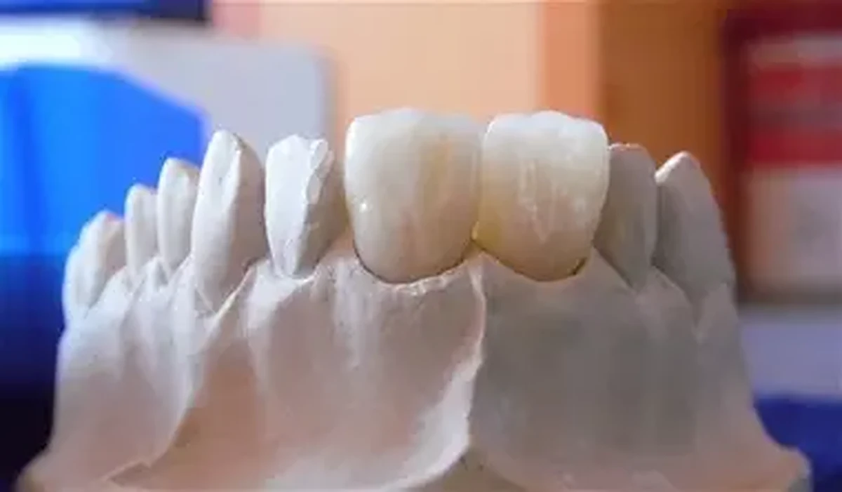 Restaurari protetice din zirconiu si E.max realizate de Laborator Dentar CDL