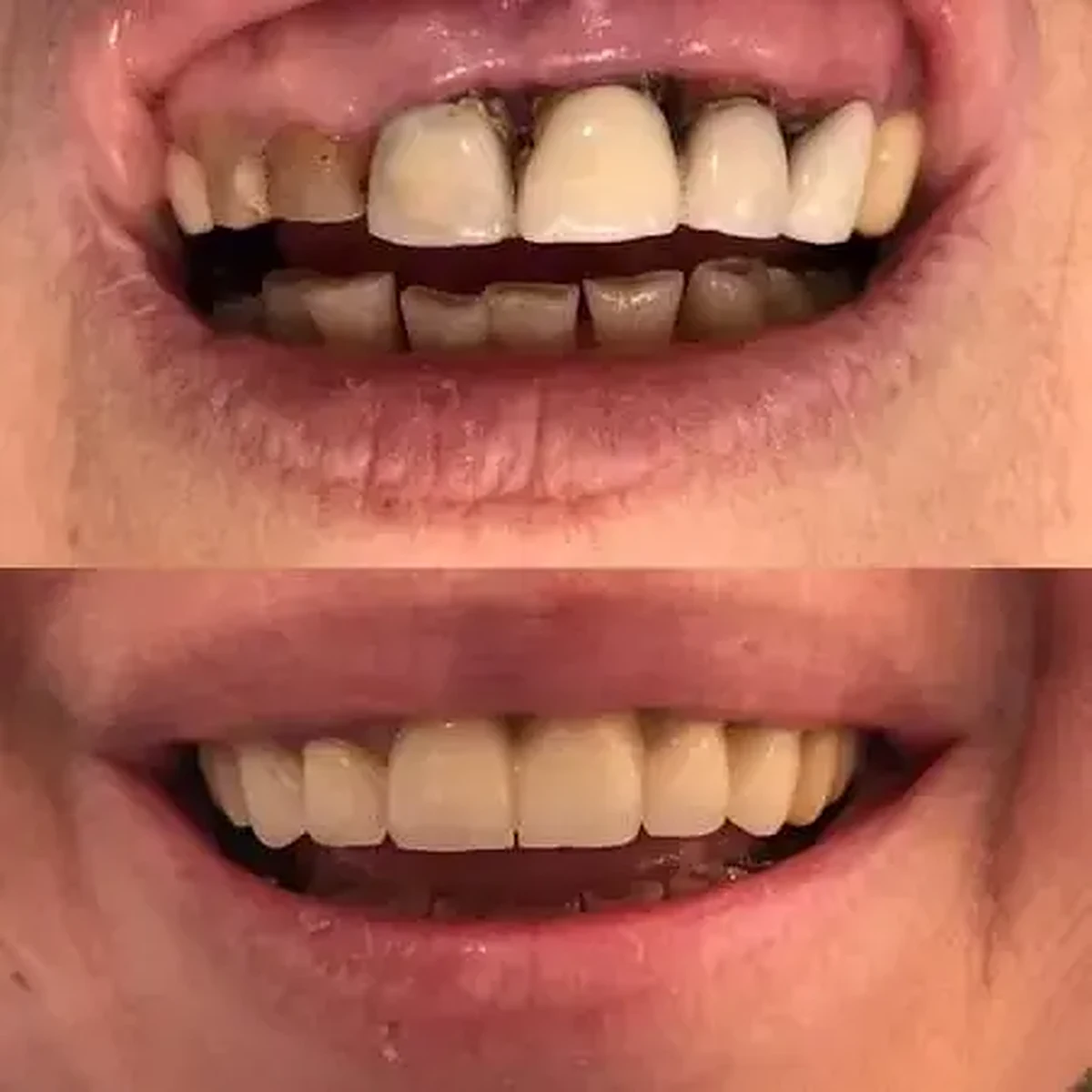 Lucrare protetica finalizata cu aspect natural