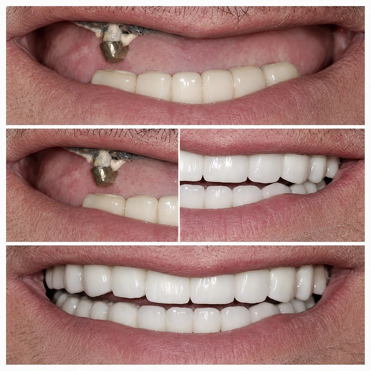 Lucrare protetica personalizata pe implanturi