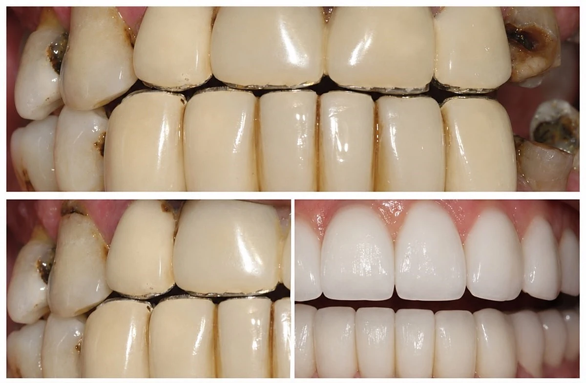 Portofoliu de lucrari protetice Laborator Dentar CDL
