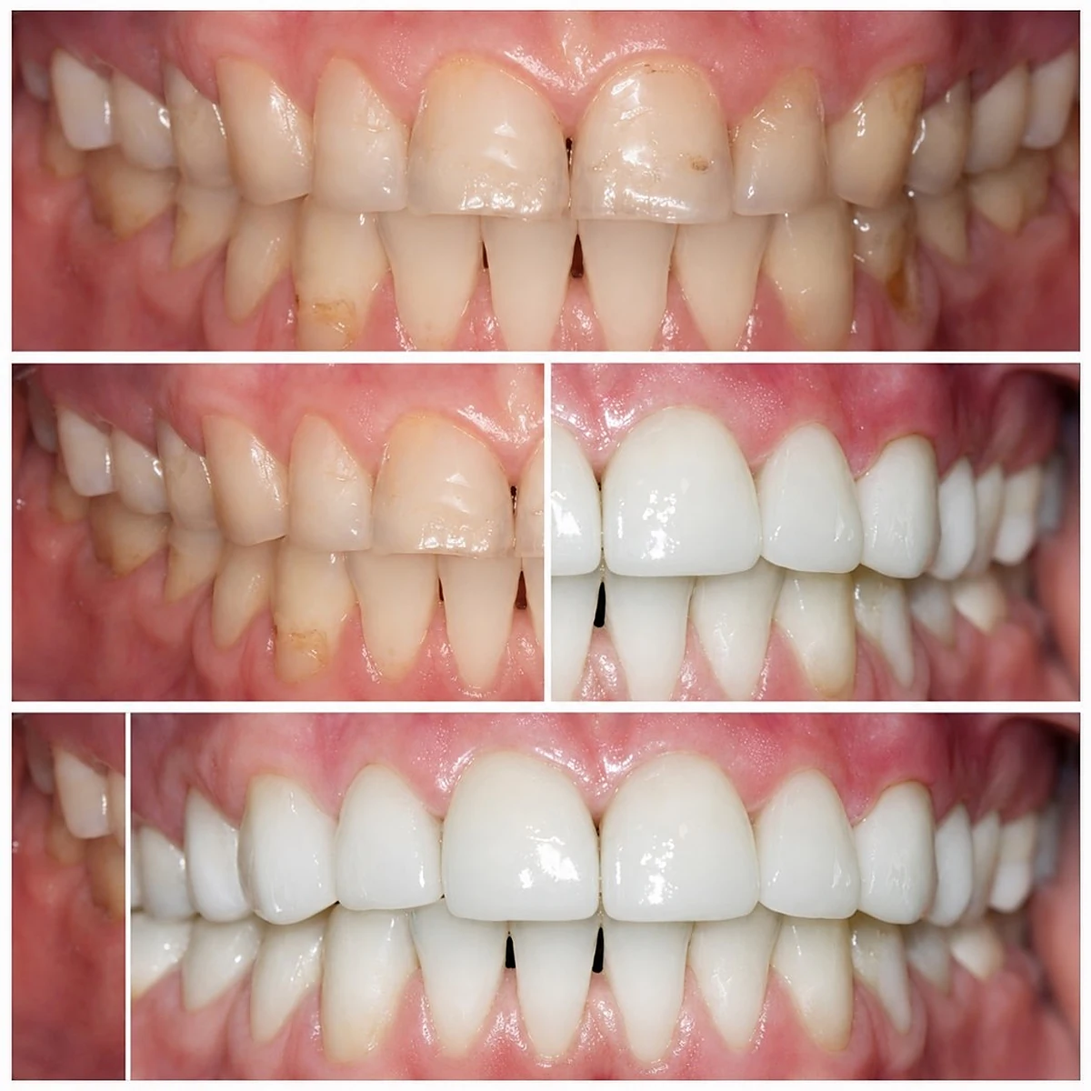 Restaurare protetica completa cu obiectiv functional si estetic